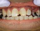 Anterior-Fillings-Before-Image