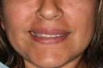Anterior-Crowns-Before-Image