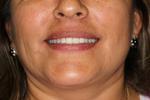 Anterior-Crowns-After-Image