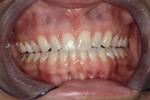 Invisalign-After-Image