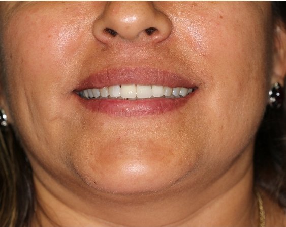 A close-up of a smiling woman showcasing her teeth, possibly after a dental procedure. Her lips are slightly parted, revealing bright and well-aligned teeth. | Collins & Sampson Family & Cosmetic Dentistry
